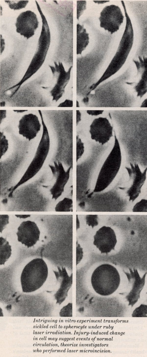 A photograph originally taken by Linus Pauling showing the transformations from sickled cell to spherocyte under ruby laser irradiation. Use by permission of: Special Collections & Archives Research Center at Oregon State University. 